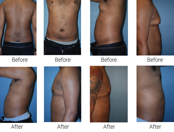 beforeafter